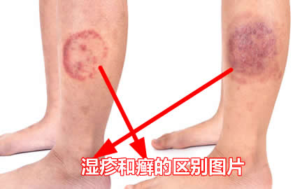 如何区分体癣与湿疹