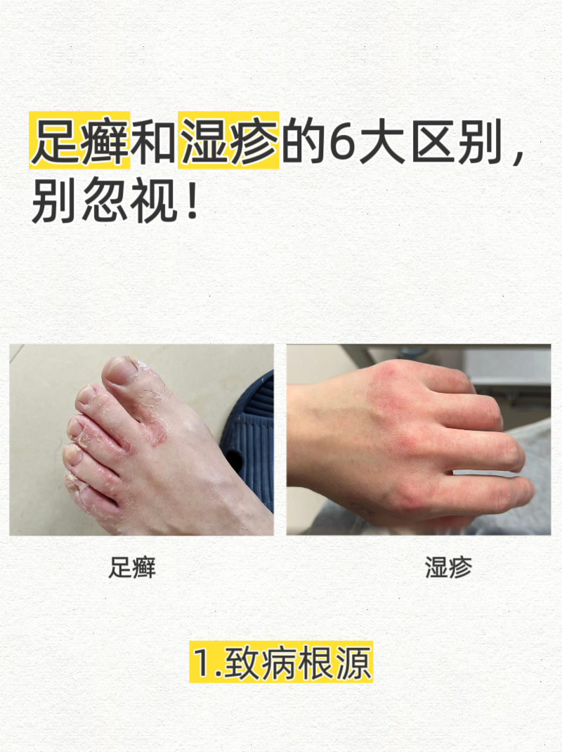如何区分体癣与湿疹