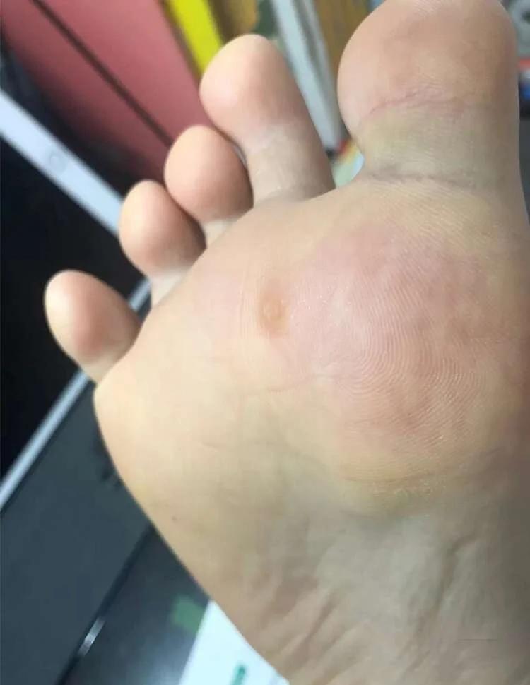 鸡眼不治会怎么样