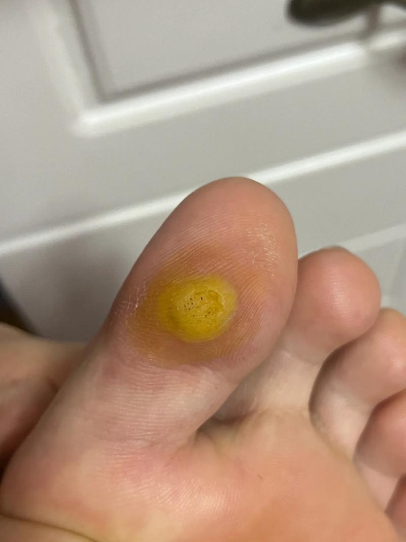 鸡眼不治会怎么样