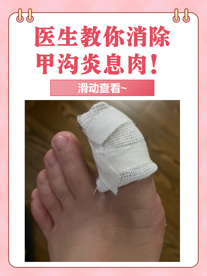 甲沟炎怎么根治