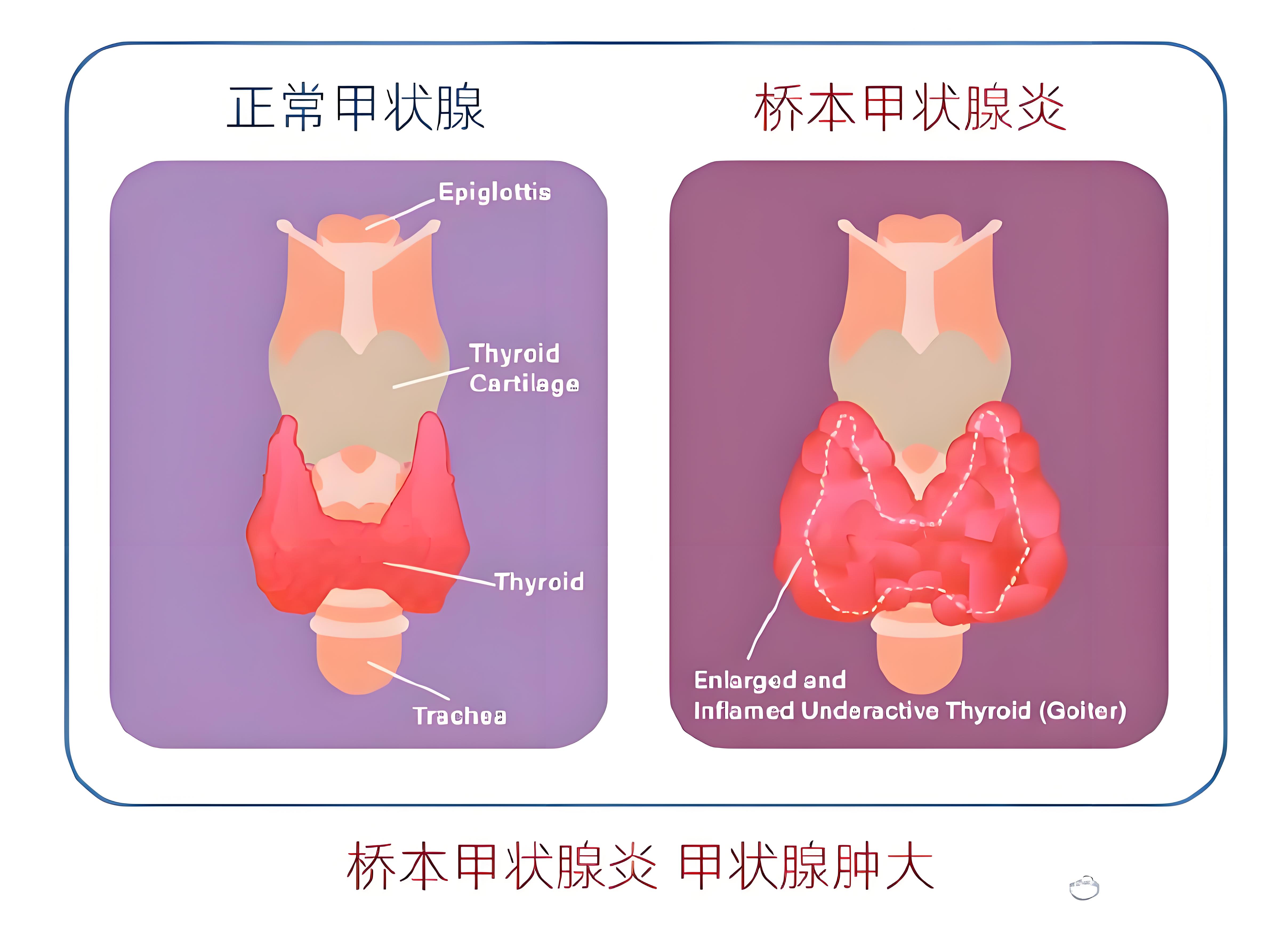 桥本氏甲状腺炎会死吗
