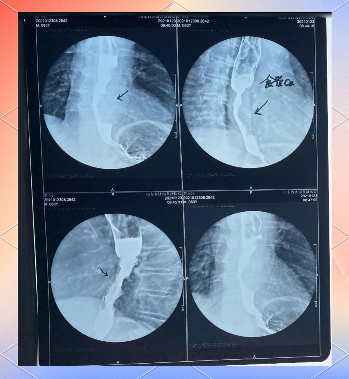 胃壁增厚是什么病?