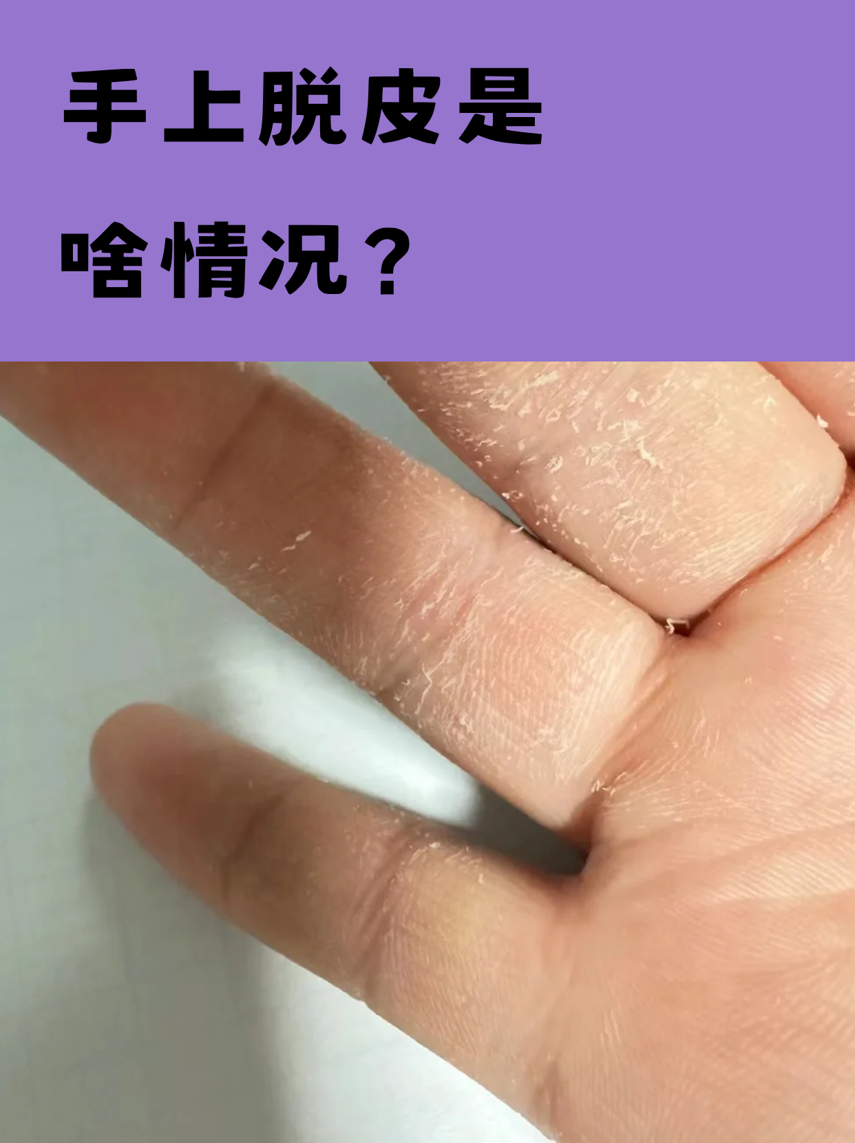 手脱皮是怎么回事?