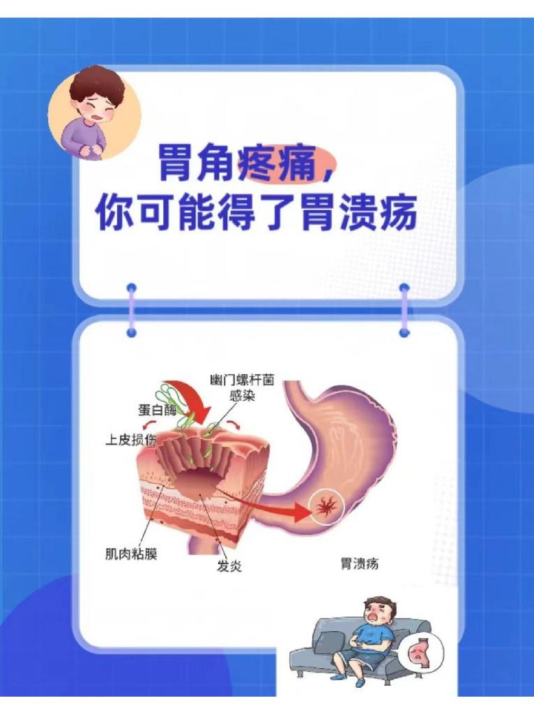 胃溃疡的好发部位?