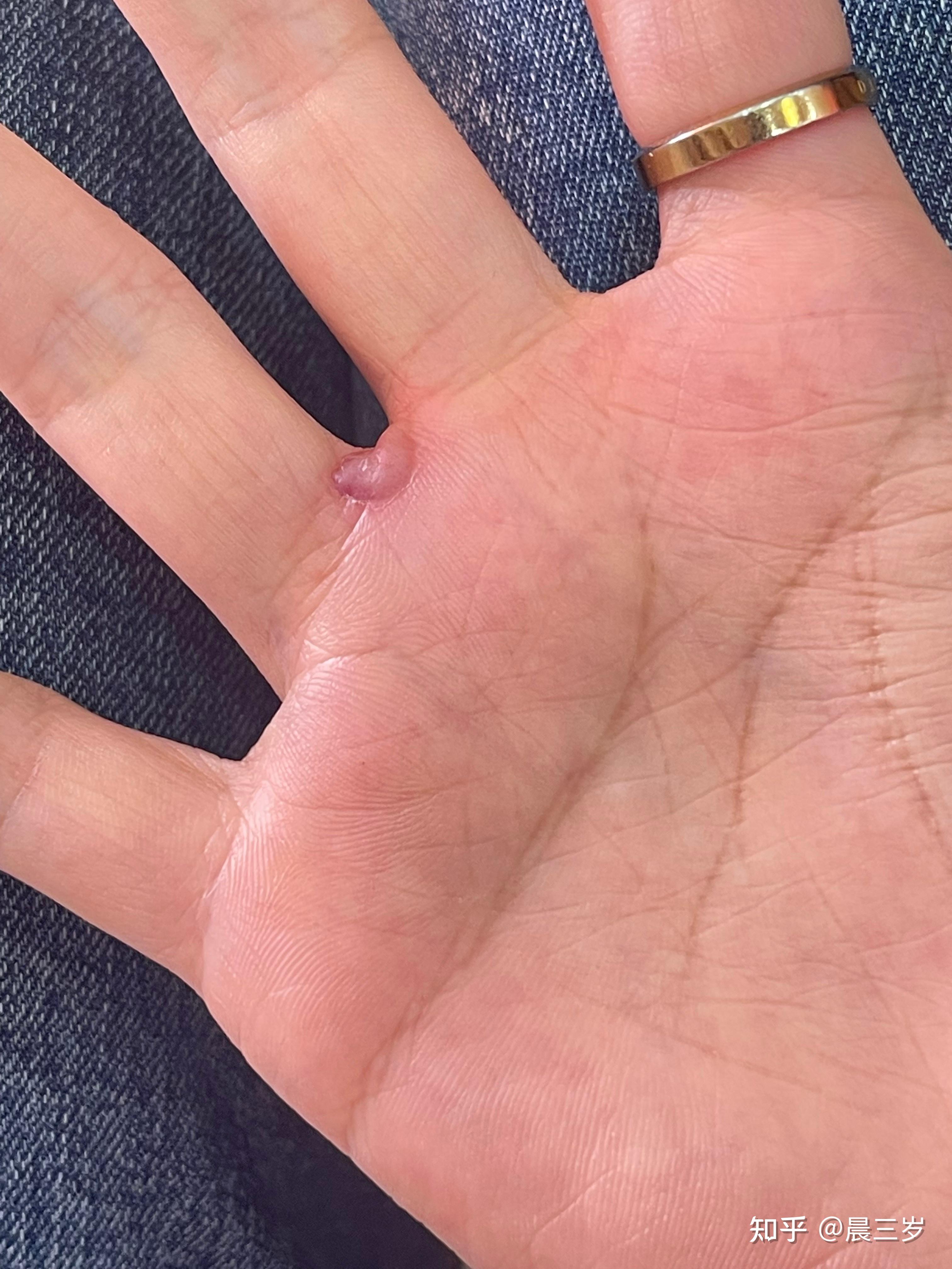 寻常疣冷冻后掉落过程