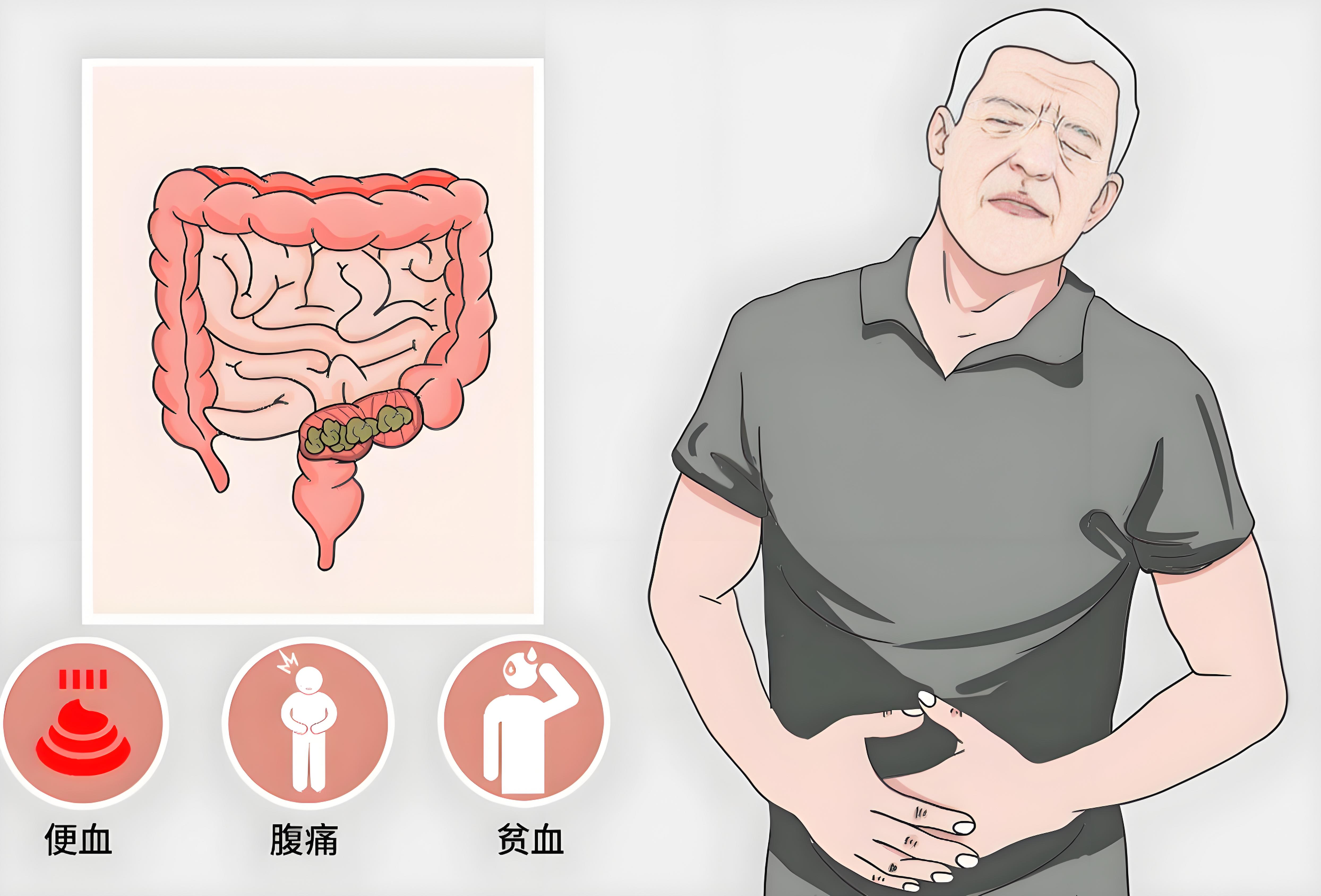 肠癌的晚期症状有哪些?