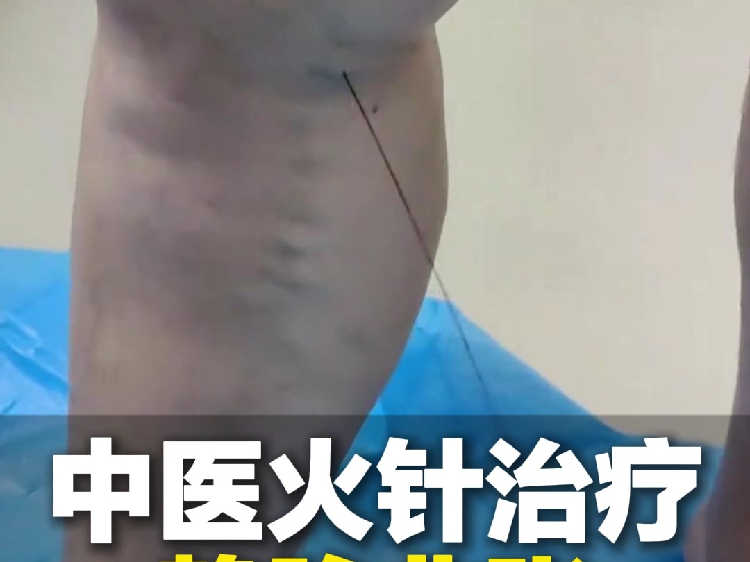 静脉曲张中医治疗
