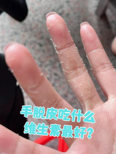 手蜕皮是缺什么?