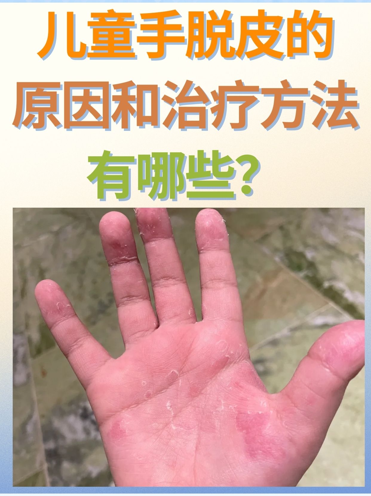 手蜕皮是缺什么?