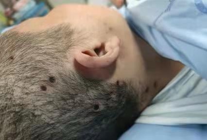 被马蜂蛰了第三天,伤口看起来像个洞一样的