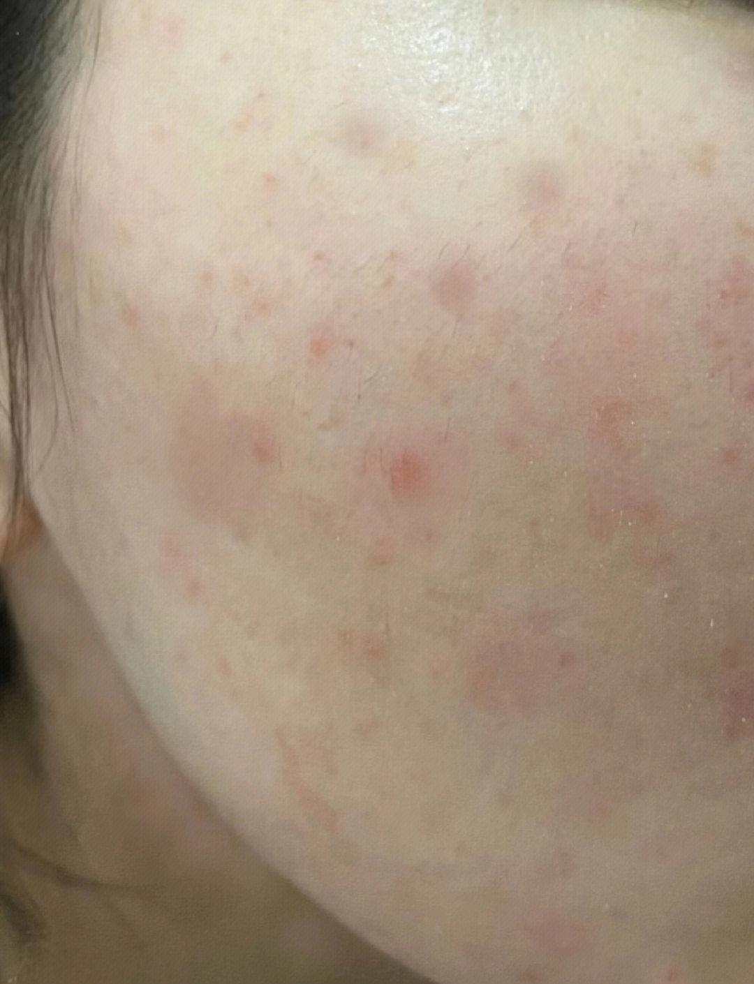 脸上长了红疹怎么回事