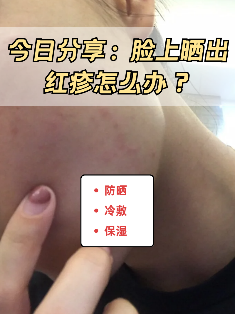 脸上长了红疹怎么回事