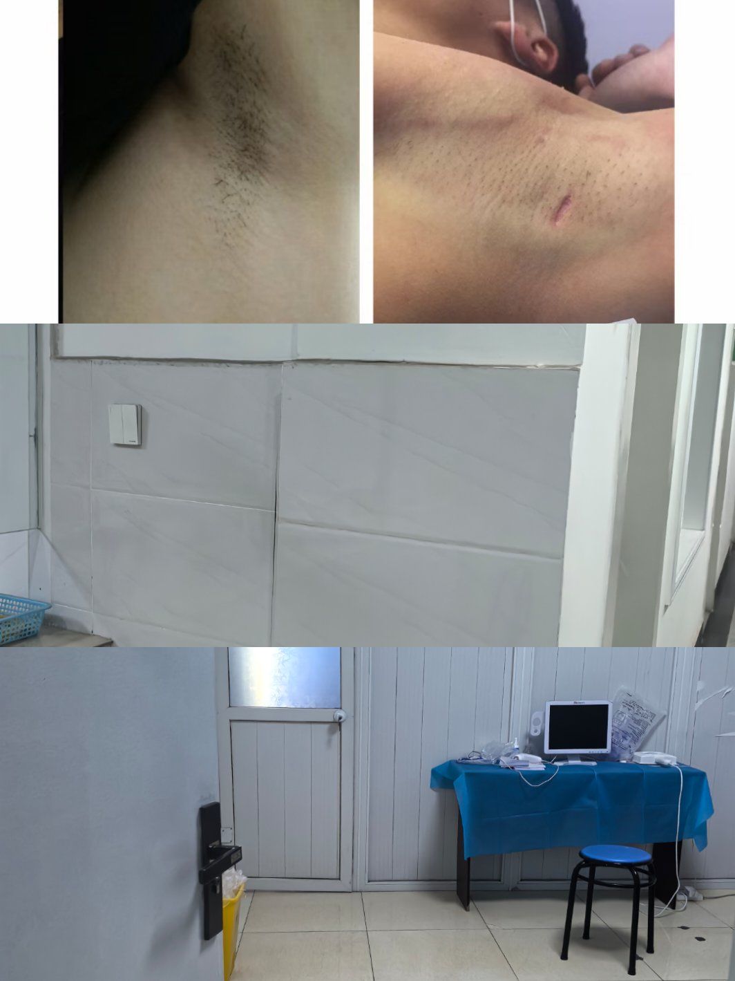 腋臭手术后多久能恢复?