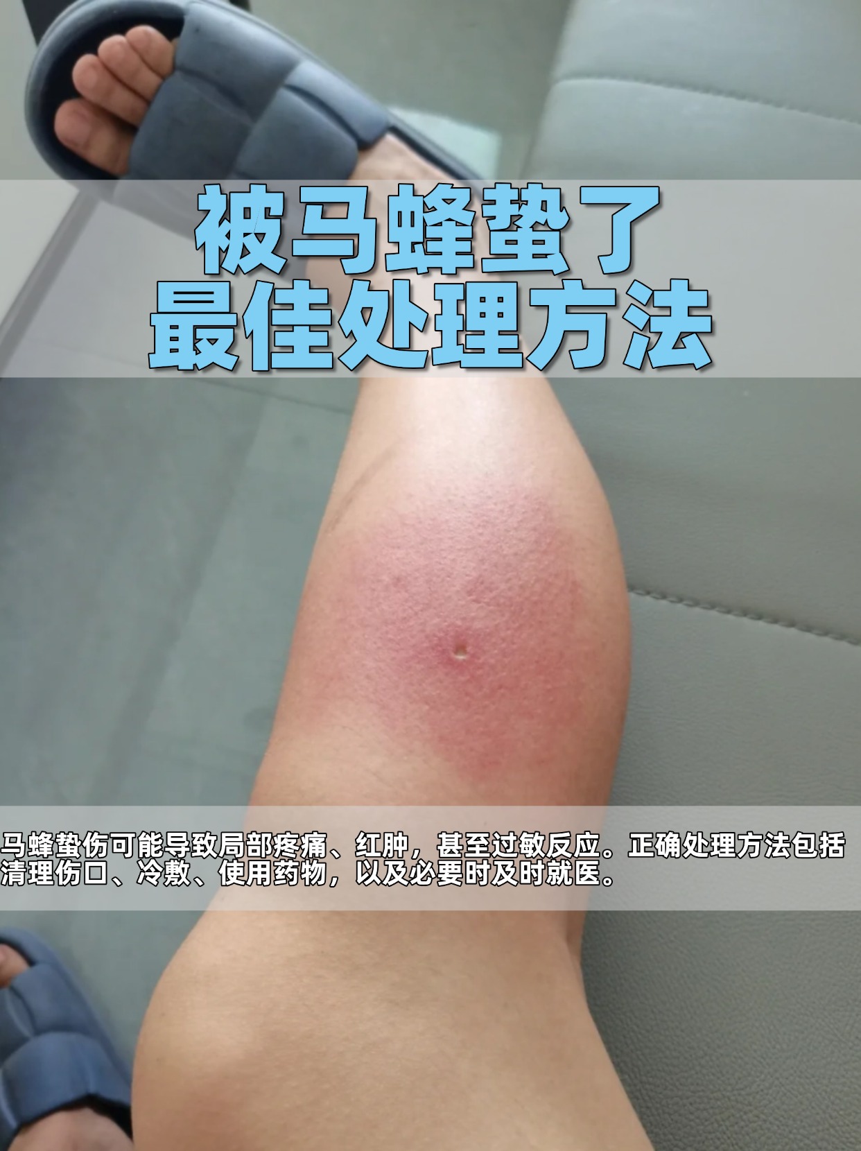 手指被蜜蜂蛰肿了怎么消肿