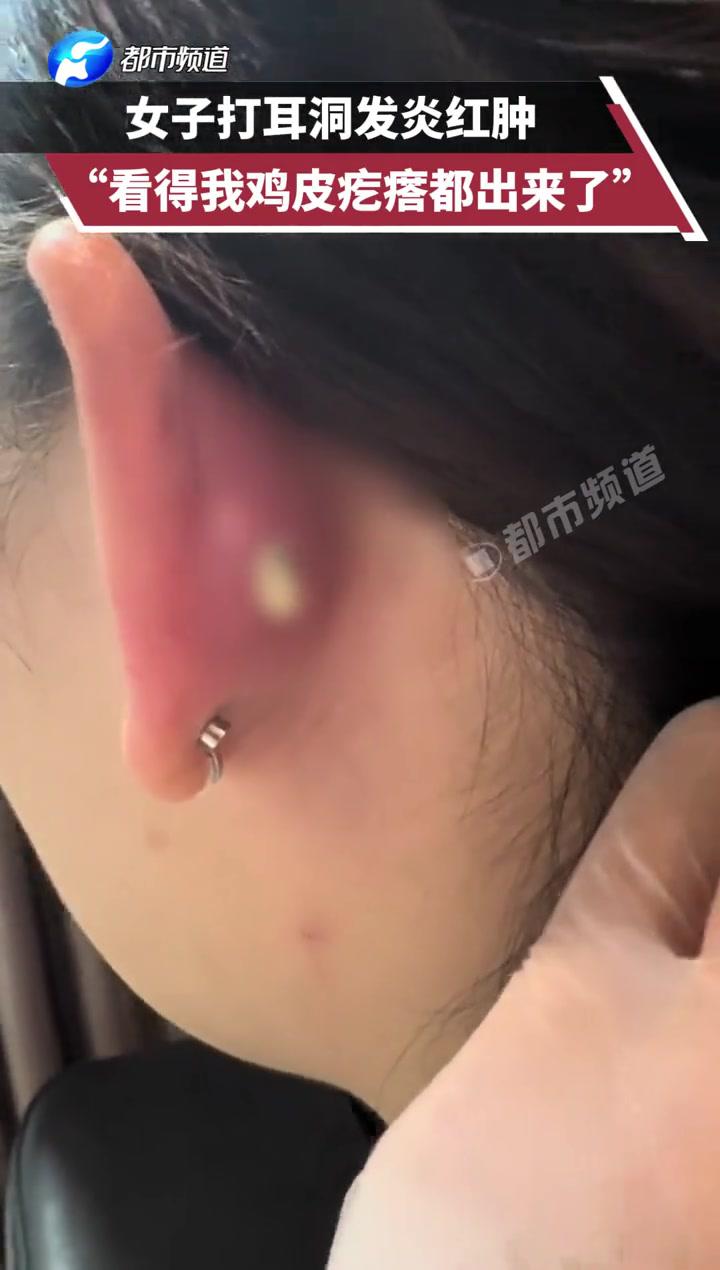 打耳洞后发炎了怎么办