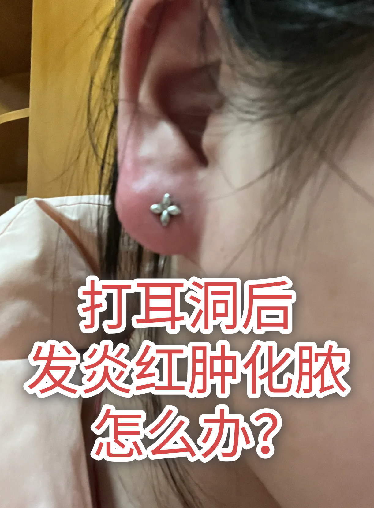打耳洞后发炎了怎么办