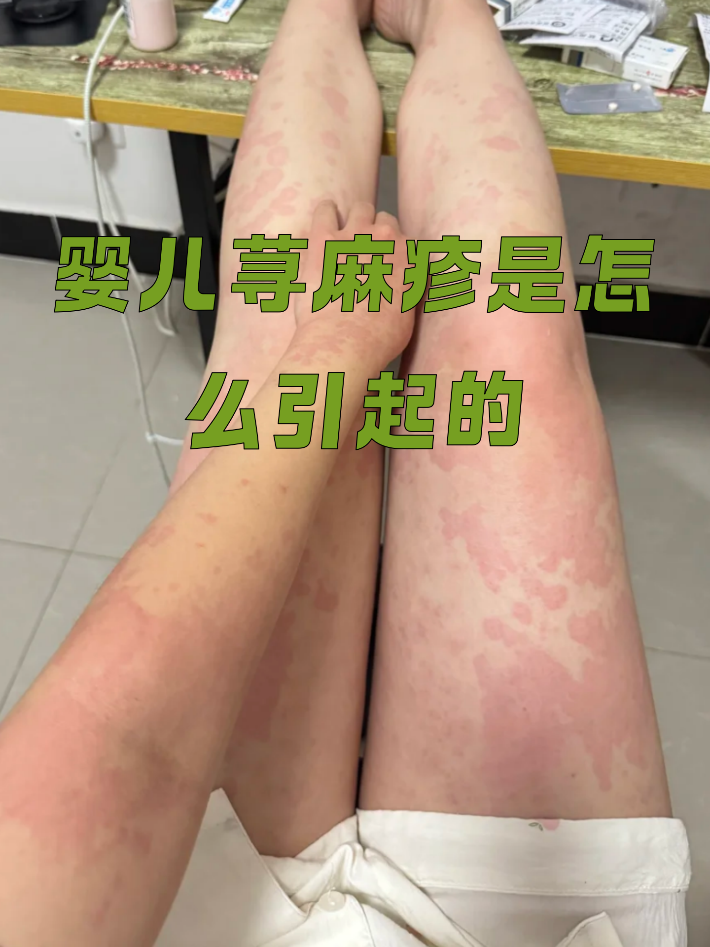 宝宝身上起红疙瘩怎么办