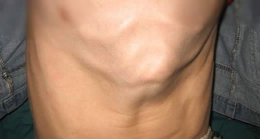 什么是鸡胸,鸡胸有什么危害