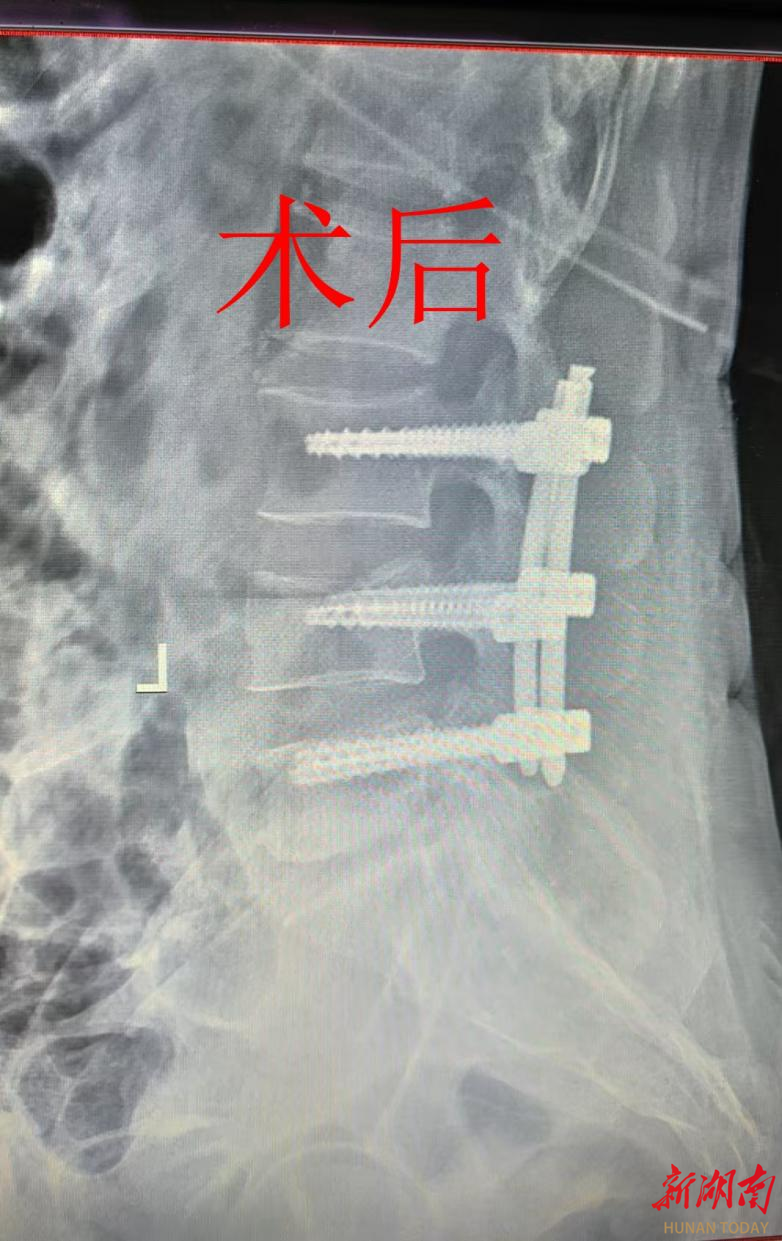 腰部骨折严重吗