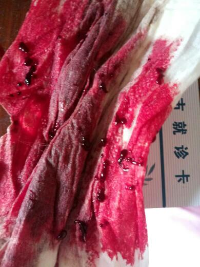 月经有血块正常吗