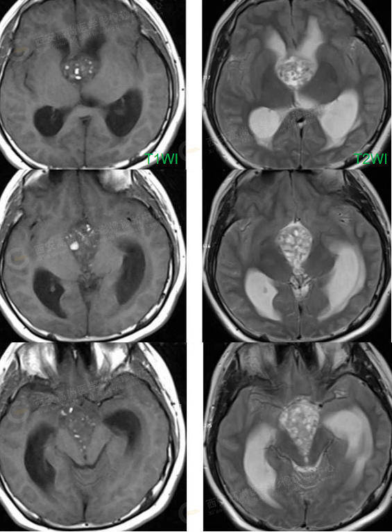 颅咽管瘤是什么病?