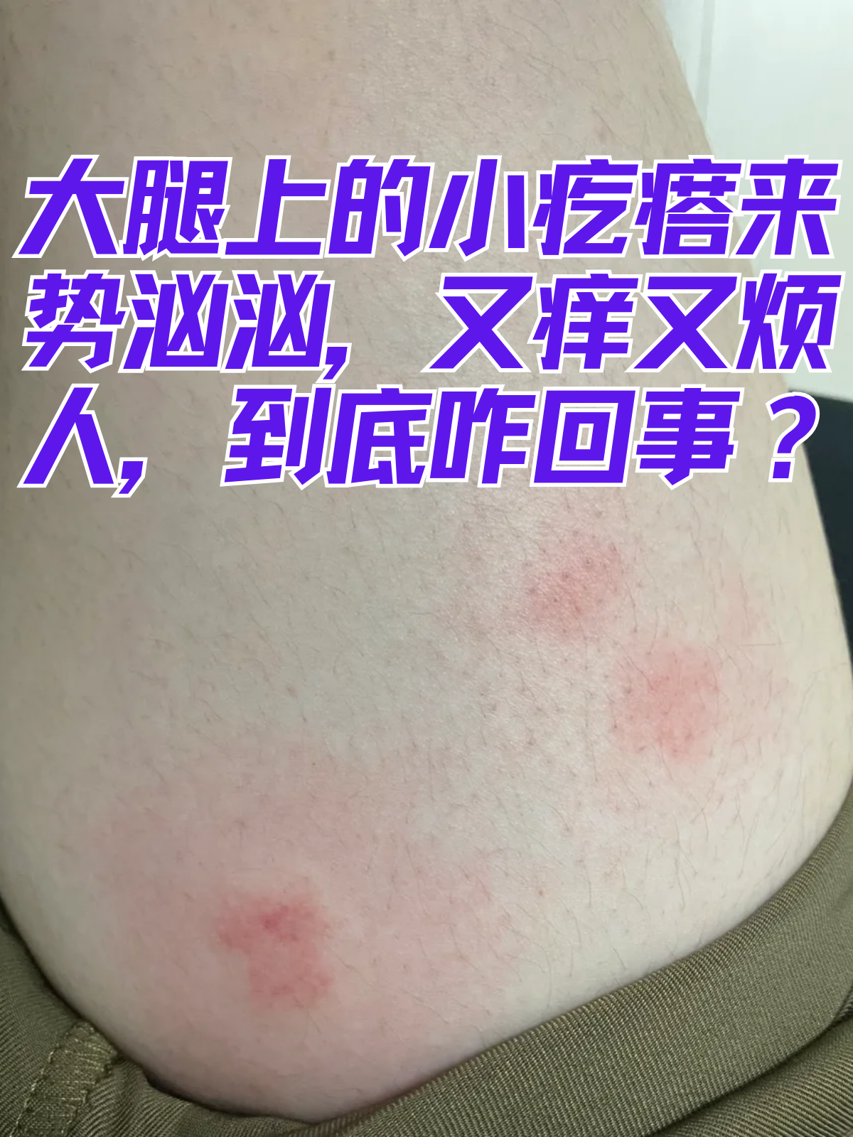 皮肤瘙痒起红疙瘩怎么处理