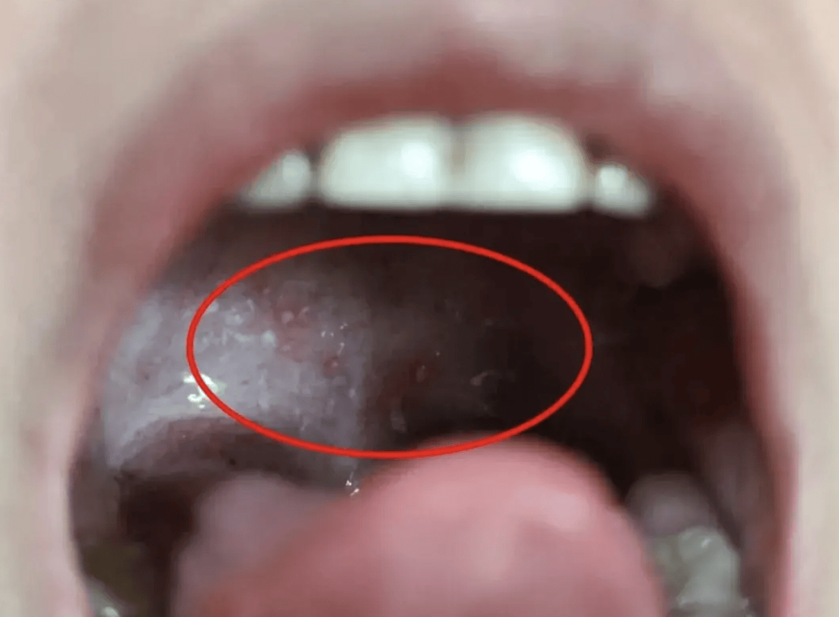 喉咙里有饭粒,咳不出