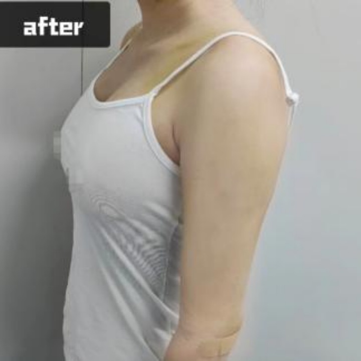 乳房缩小手术后影响哺乳吗