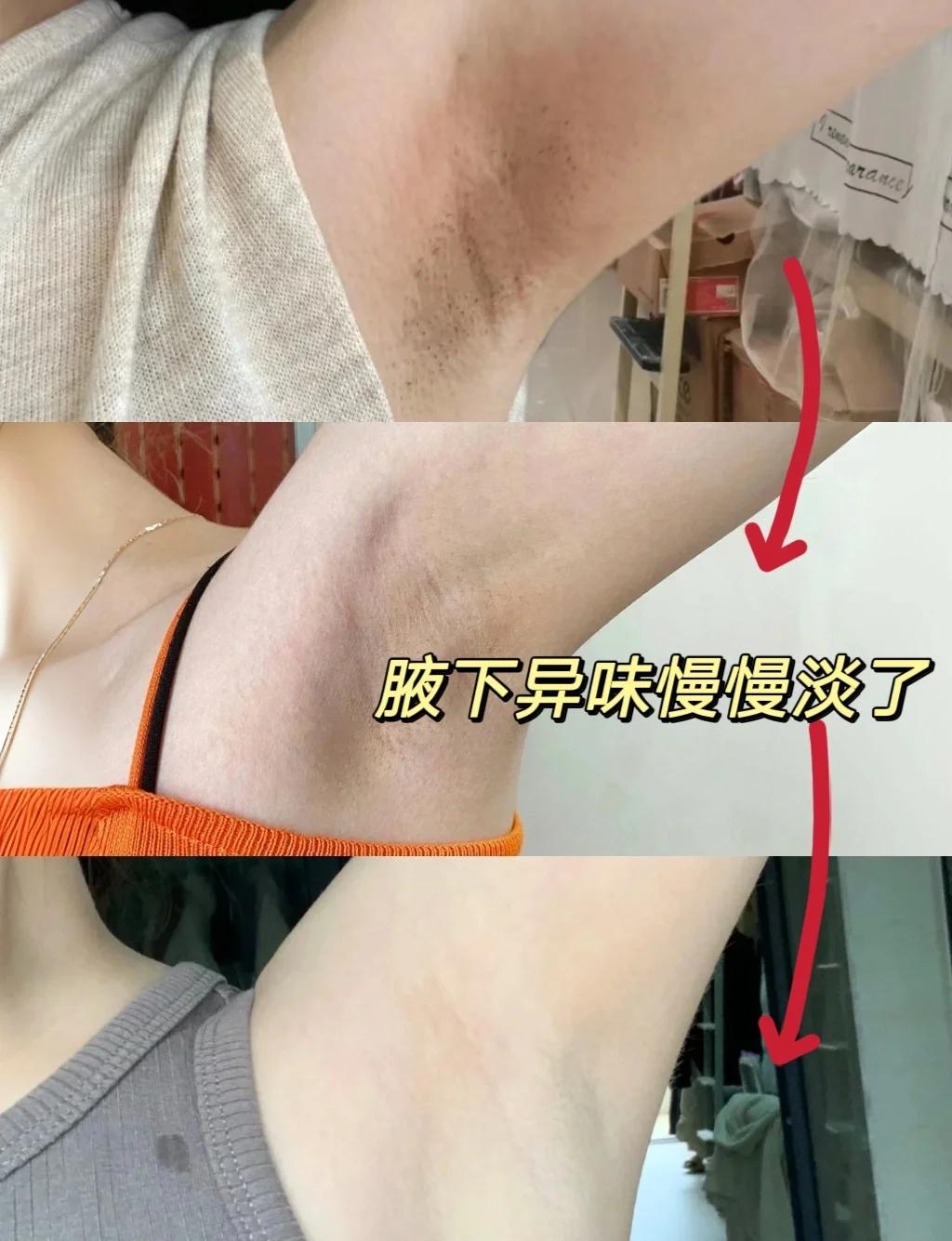 腋毛上有白色的东西怎么去除