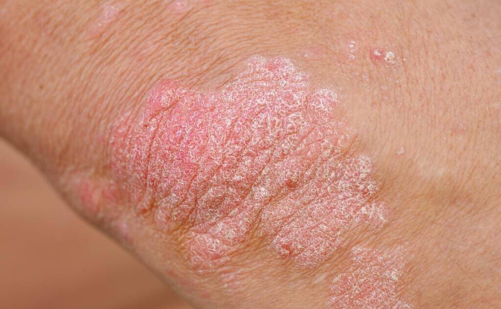 外阴白斑是严重的病吗