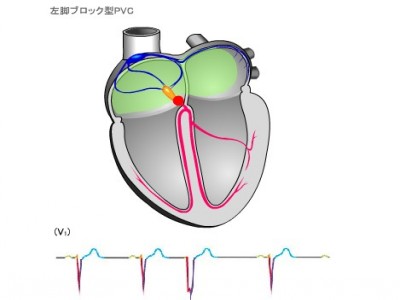 偶发室性早搏怎么回事