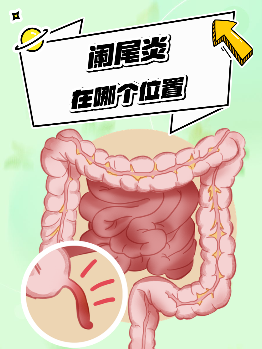 阑尾炎在哪里痛
