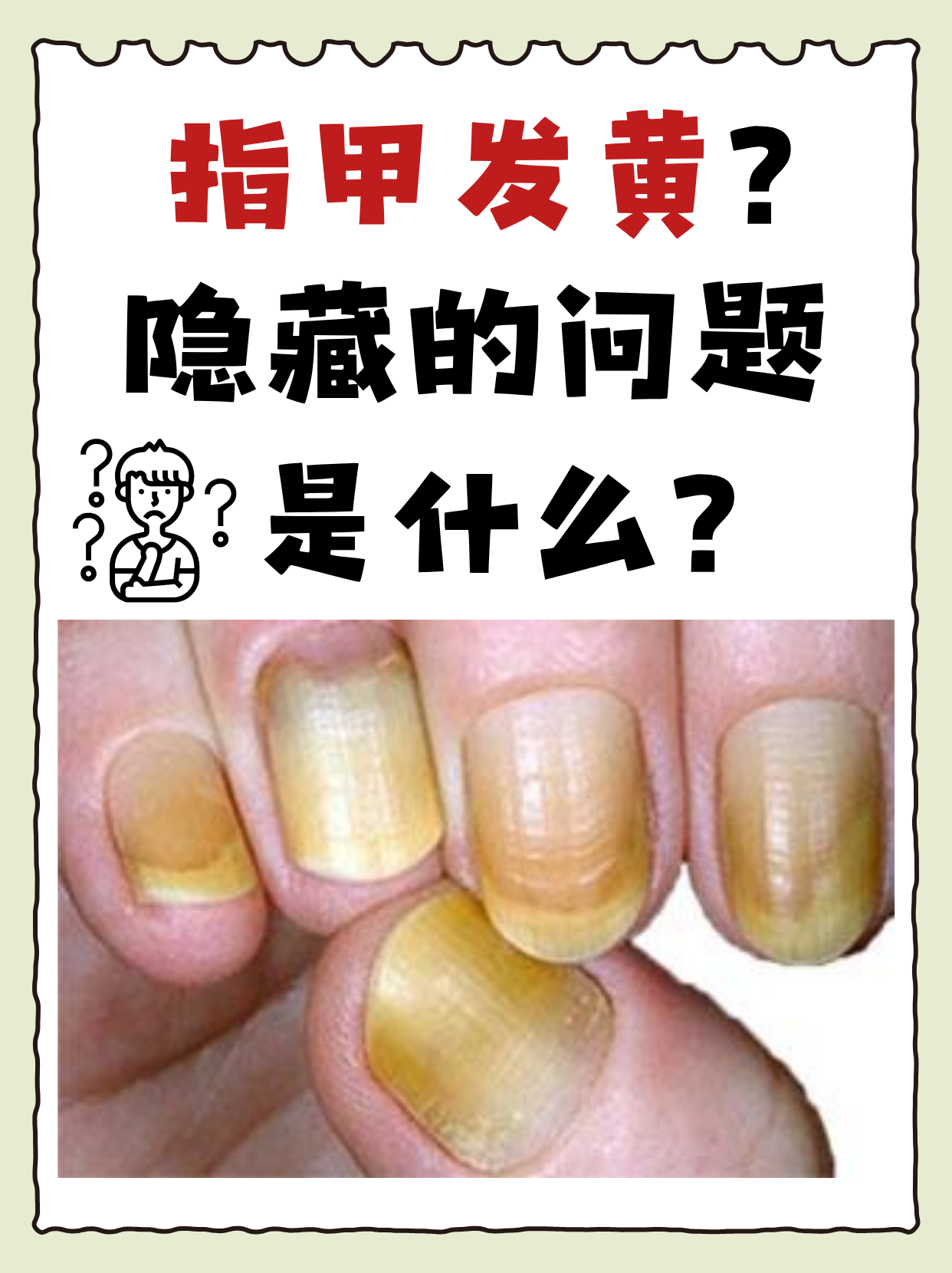 指甲凹凸不平是怎么回事?