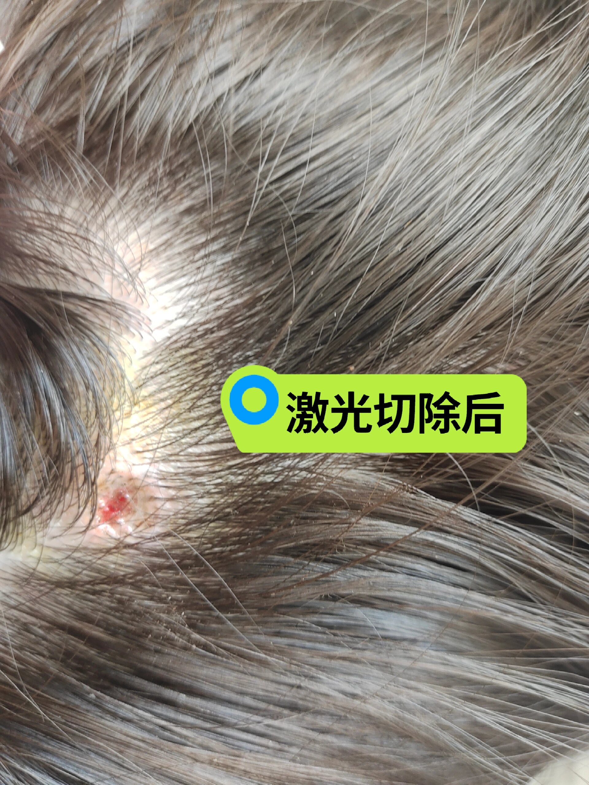 头上长包是癌症的前兆吗?