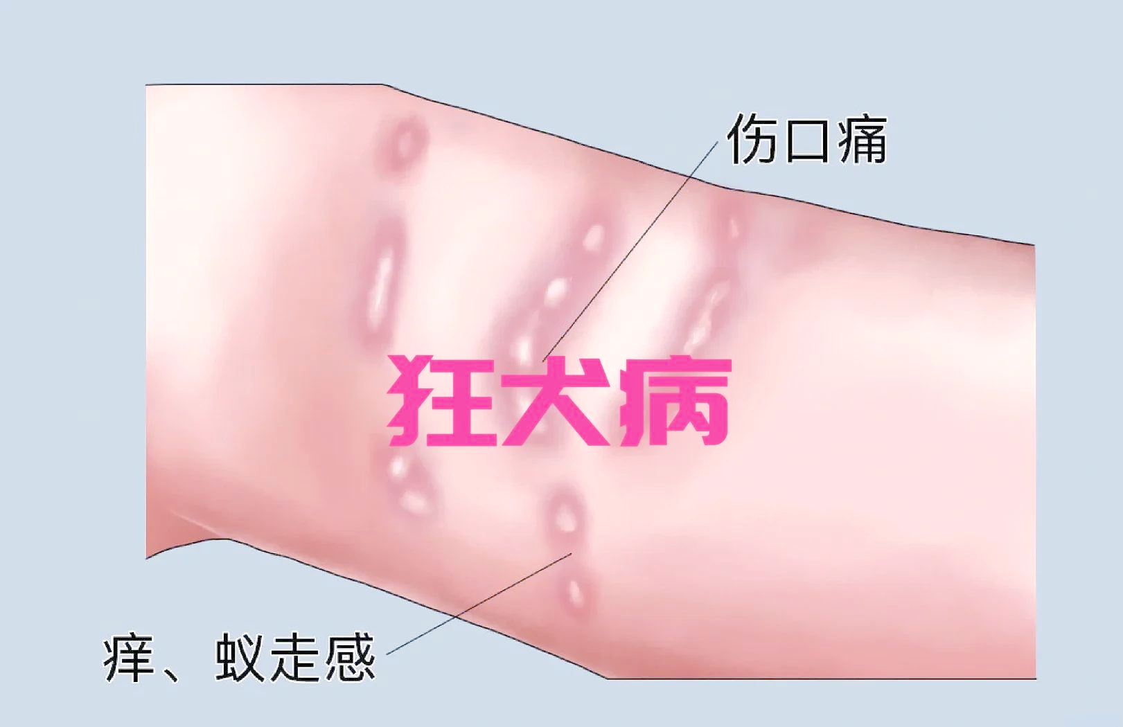 狂犬病什么情况下会感染