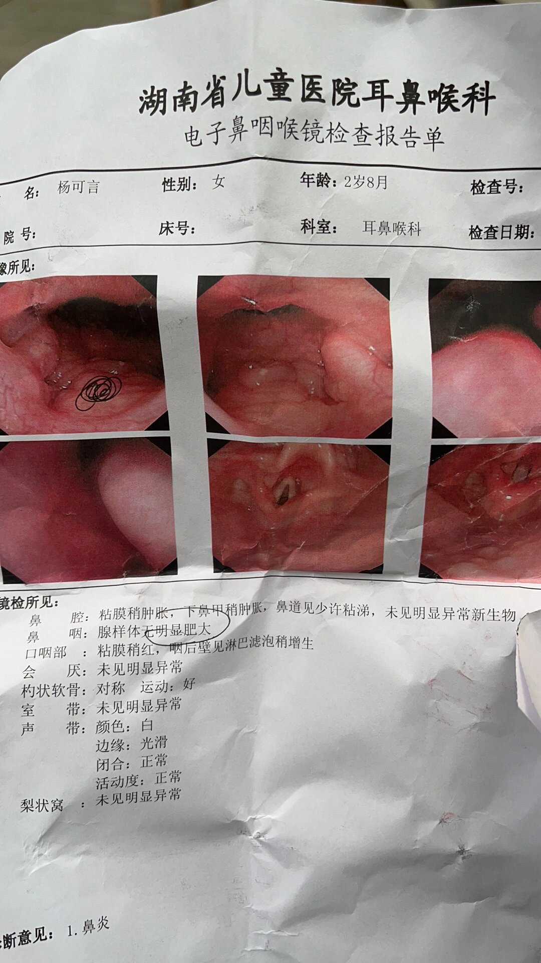 腺样体肥大手术有什后遗症