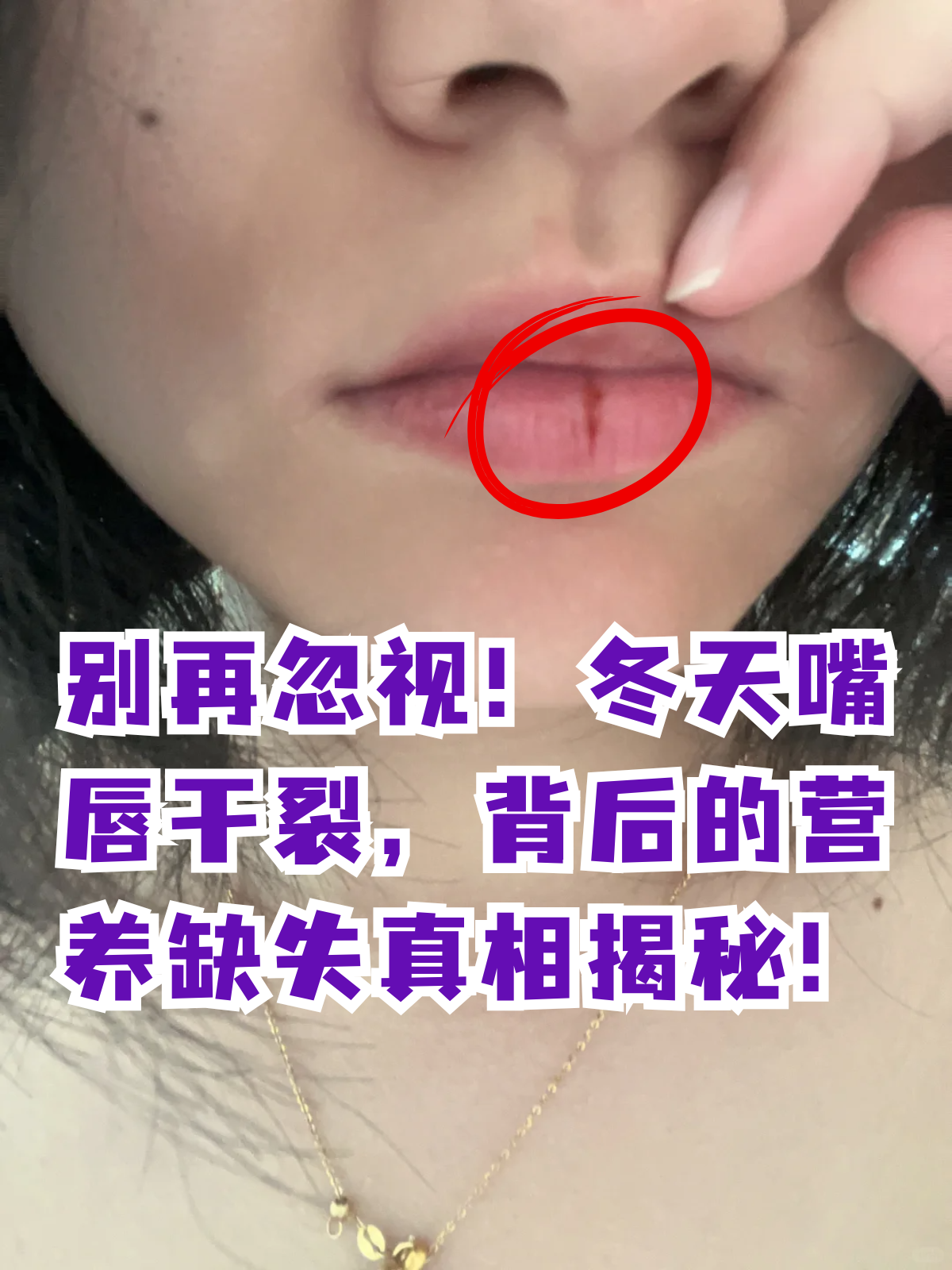 嘴唇干,起皮是怎么回事