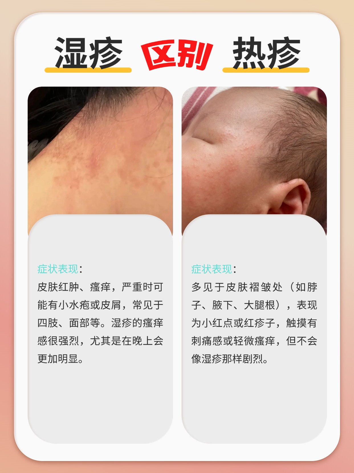 新生儿痤疮和湿疹的区别