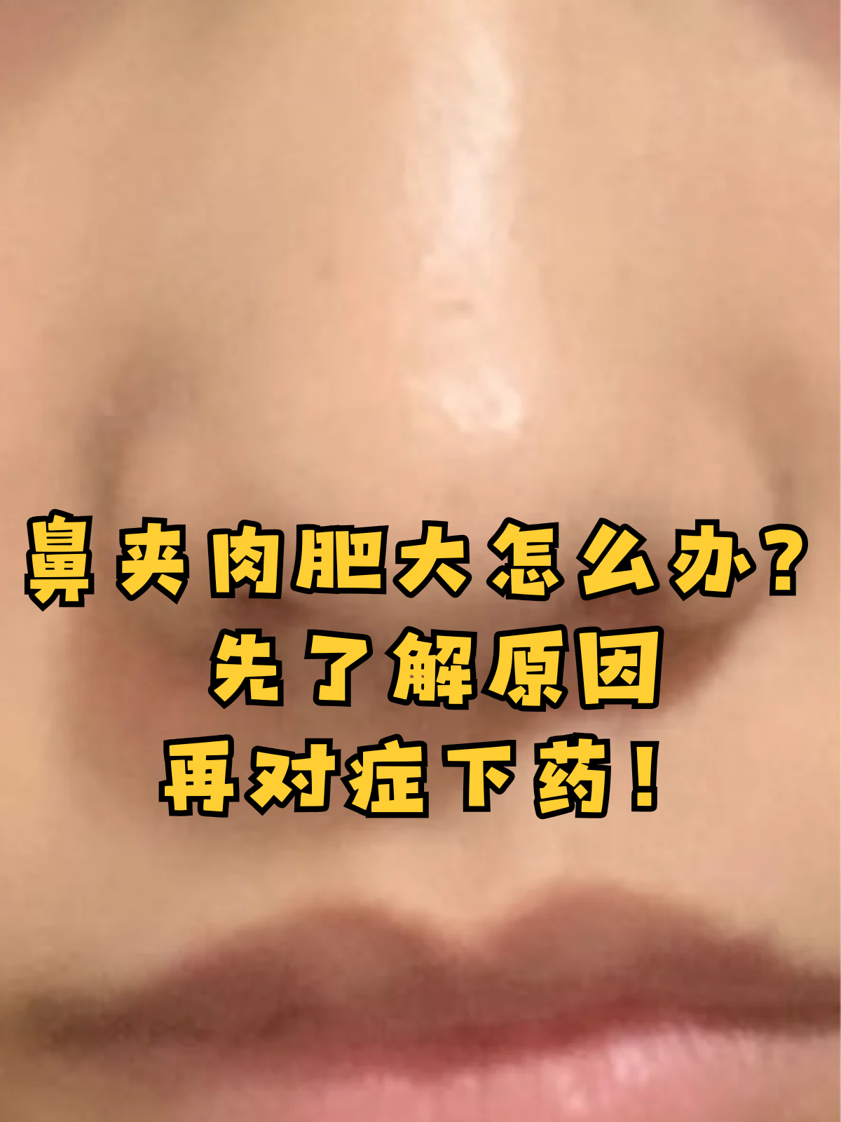 鼻甲肥大一般有哪些症状