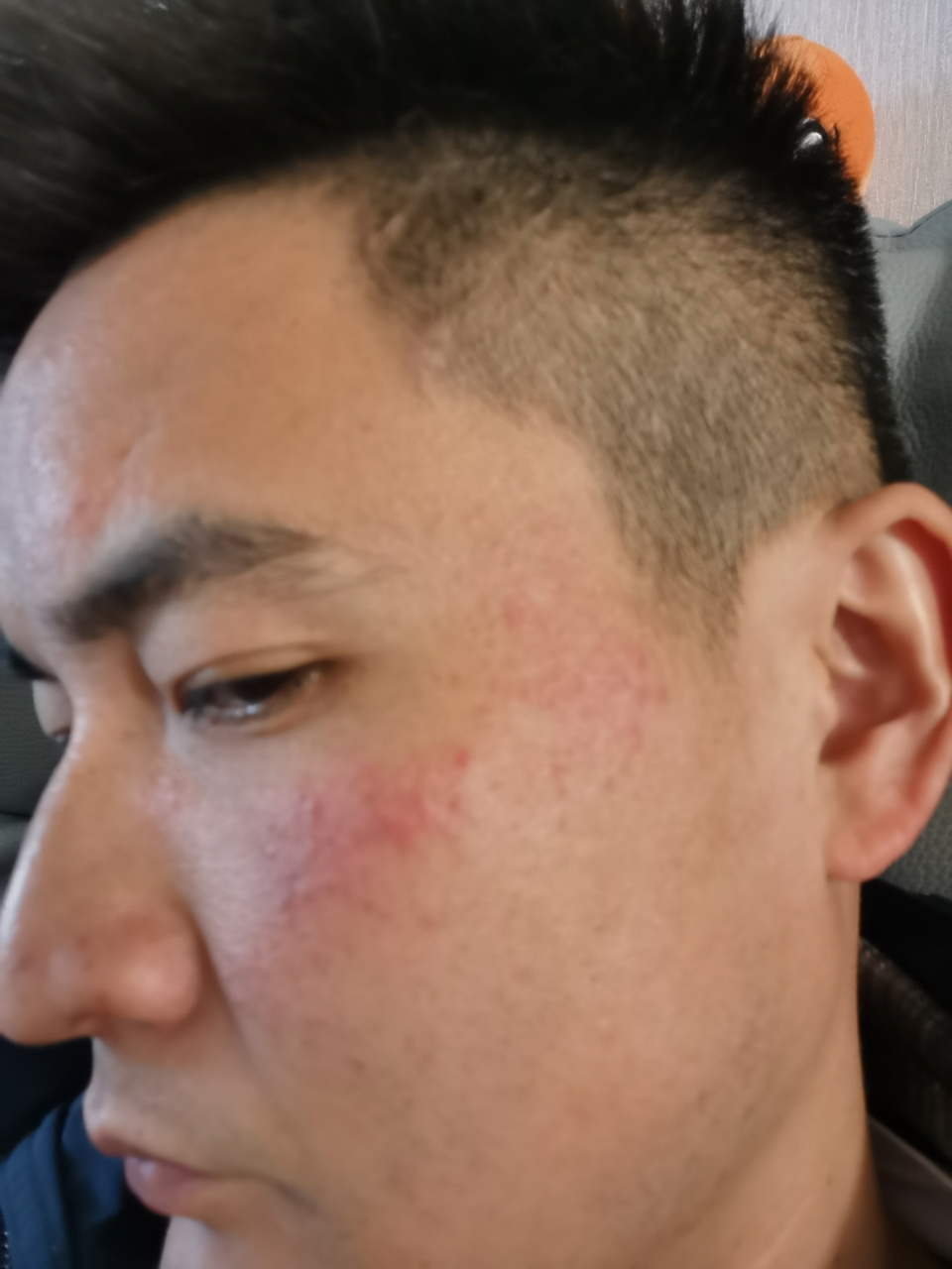 脸上长红斑是怎么回事