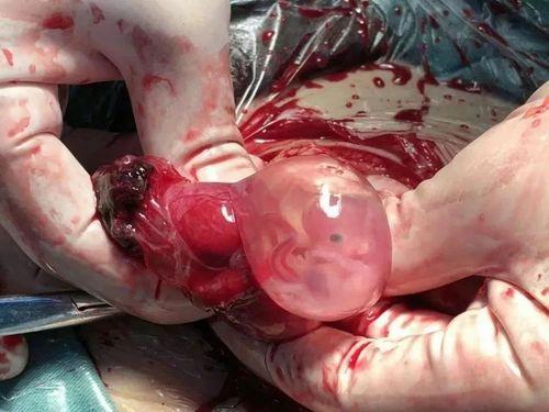 宫外孕可以生下来吗