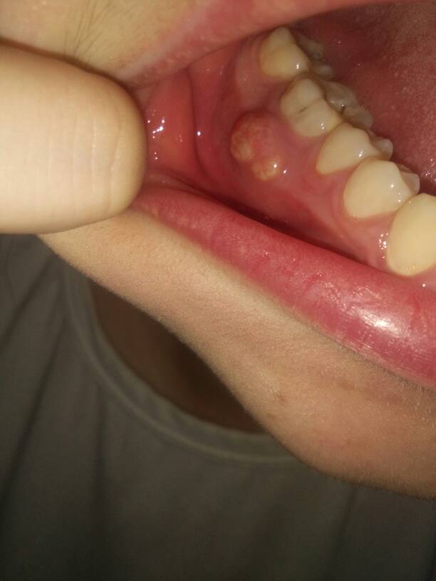 牙龈上长了个红色肉芽
