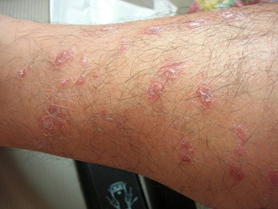 结缔组织病早期有什么症状