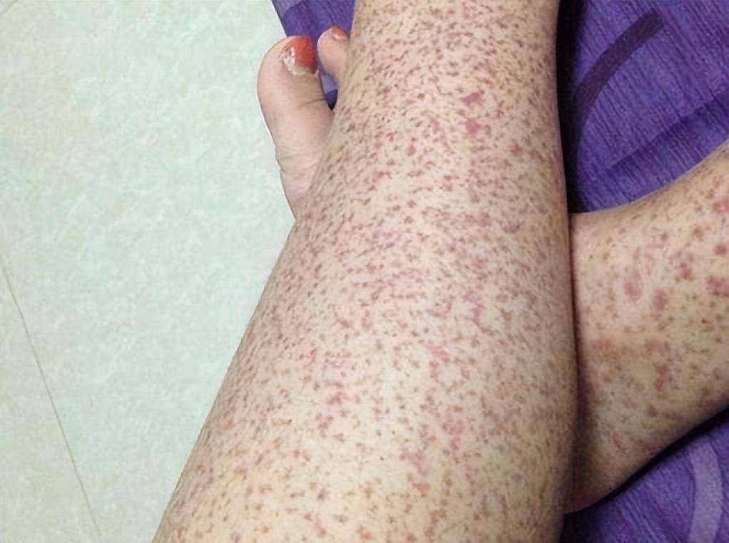 儿童过敏性紫癜严重吗