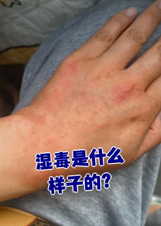 湿毒是什么症状