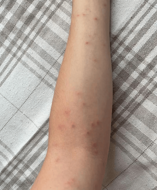 湿毒是什么症状