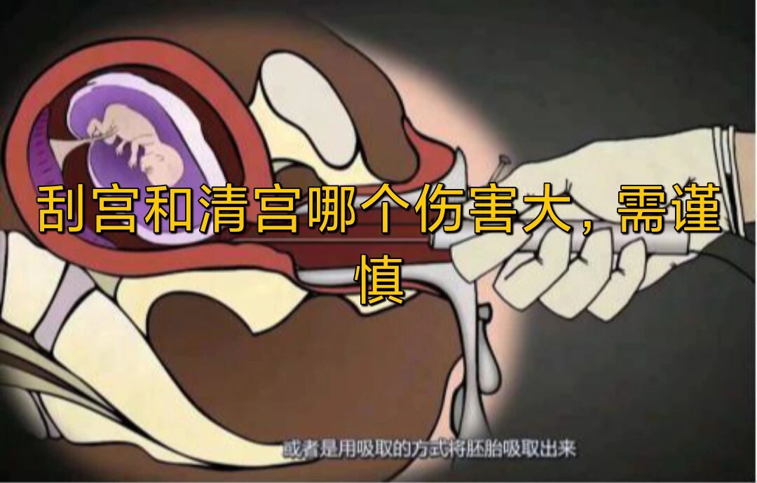 刮宫和清宫一样吗