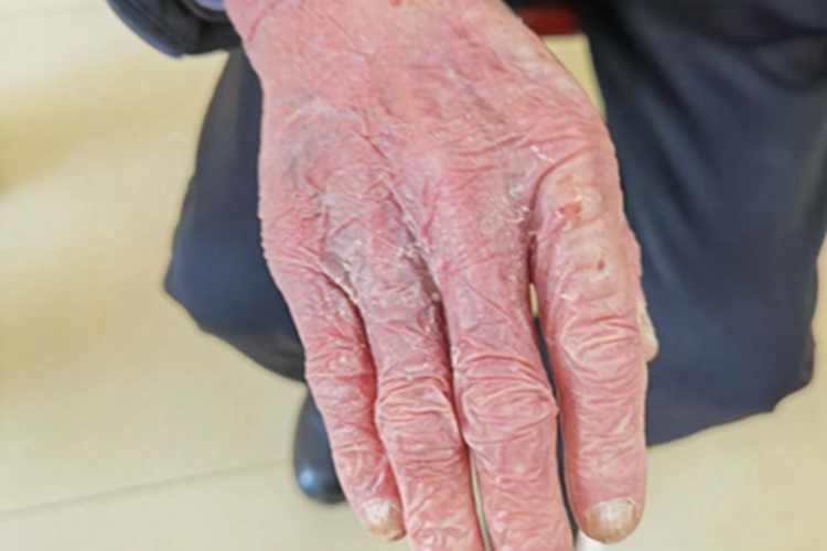 皮肤萎缩怎么办