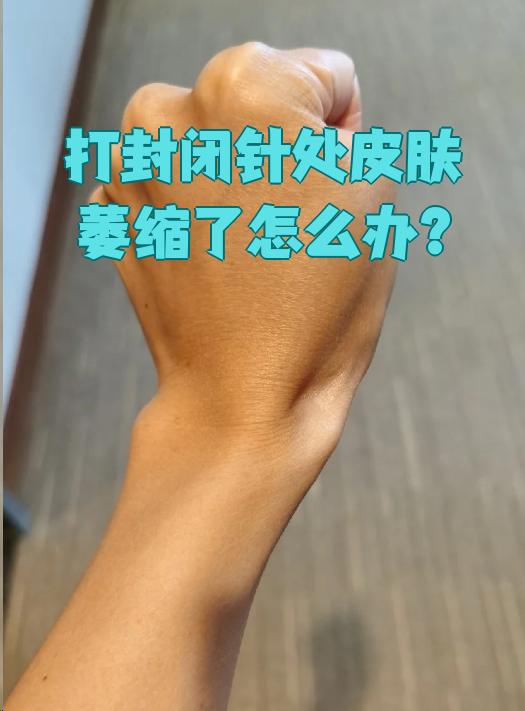 皮肤萎缩怎么办